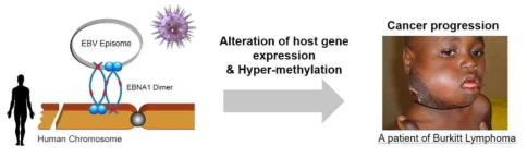EBV 원인의 암 발생