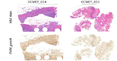난소전이암에서 OVM_gene4의 발현(대표케이스)