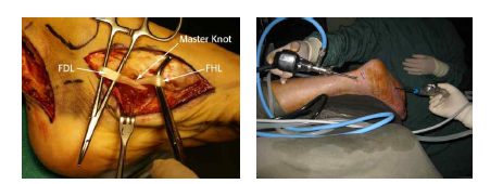 왼쪽, 긴엄지굽힘근힘줄(flexor digitorum longus tendon)과 긴발가락굽힘근힘줄(flexor hallucis longus tendon)의 교차점. 오른쪽, Henry’s knot 부위의 윤활주머니염(tenosynovitis; bursitis) 치료를 위한 관절경 수술