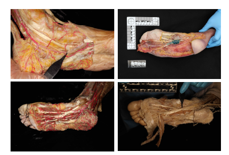 Henry's knot부위의 안쪽발바닥동맥과 신경의 위치를 해부하여 계측한 사진 Photos of dissection specimens showing the positional relationship between the medial plantar artery and nerves at Henry's knot (crossing point of flexor hallucis longus tendon and flexor digitorum longus tendon)