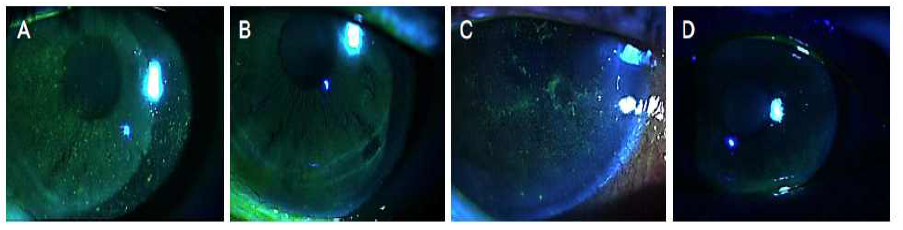 (수식) Slit-lamp photograph of two patients with refractory filamentary keratitis. (A, B) The lefr eye of 42-year-old woman with sj gren′s syndrome, 62 filaments were observed in the entire area. After 90 days of 10% N-acetycysteine treatment, complete re-mission was observed. (C, D) The left eye of 39-year-old woman with dry eye syndrome, 36 filaments were observed in especially interpalpebral area. After 48 days of 10% N-acetylcysteine treatment, complete remission was observed