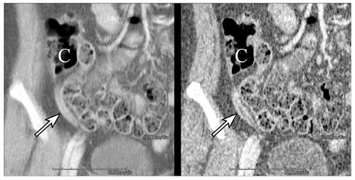 복부 CT 영상에서 충수염 진단: (좌) 표준선량 CT 영상, (우) 저선량 CT 영상, 저선량 CT 영상이 표준선량 CT 영상에 비하여 화질은 떨어지지만, 충수염(화살표)을 진단하는 데에는 지장이 없음 [C: 맹장]