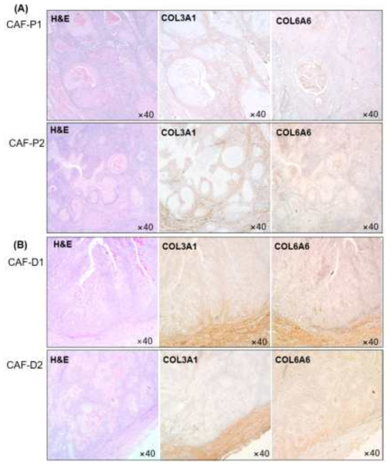 Collagen protein expression in HNSCC patients’ tissues. COL3A1 and COL6A6 protein expression was evaluated in CAF-P (A) and CAF-D (B) tissues from patients with HNSCC