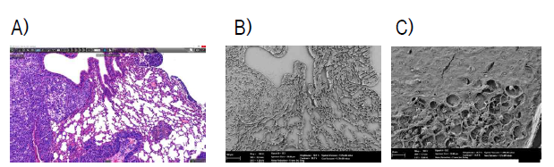 폐전이종양의 FE-SEM과 조직병리학적 검사 비교 평가 A) 폐전이종양의 H B) 폐전이종양의 FE-SEM 사진; C) B 사진의 확대상