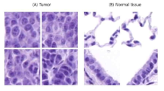 Representative histopathological figures of tumor tissue or normal tissue. (A) Tumor tissue;, (B) Normal tissue