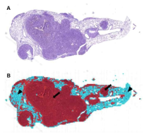 Visualization of tumor tissue or non-tumor tissue in the lung (A) Original HE image; (B) Visualized image. Red color as tumor tissue (arrow) and deep blue as non-tumor tissue (arrow head)