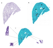 Visualization of non-tumor tissue in the lung (A) Original HE image; (B) Visualized image. Deep blue as non-tumor tissue (arrow head) and red color as tumor tissue (arrow); (C) Original image matching for misclassification of lung tissue