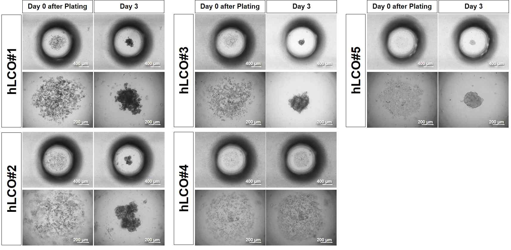 5종 인간 간암 오가노이드 세포의 Microwell Fluidic Array 내에서 3일 동안 오가노이드 형성 및 성장 비교