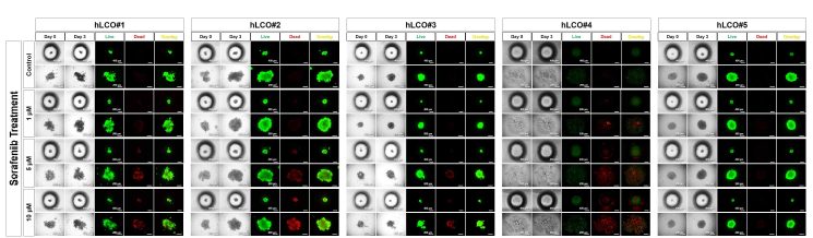 5종 인간 간암 오가노이드의 Microwell Fluidic Array 내에서 간암 임상 치료제 Sorafenib에 대한 약물 반응 테스트 형광 이미지 결과