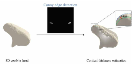 Canny edge detection 알고리듬을 적용한 피질골 경계 분리 및 두께 값 측정 과정