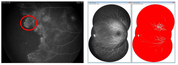 허혈성 망막질환 환자에서 정상 혈관 소실 및 혈관신생 과정의 형태학적 분석. (좌) 코우츠병 환자의 망막 허혈 부위에서 거미줄 모양 혈관신생. (우) 가족성삼출성유리체망막병증 환자에서 망막혈관 발달 과정의 형태학적 분석