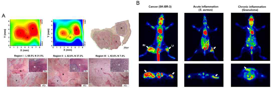 핀형 적극배율 기술을 통한 암 세포 이미징 (A) 및 암과 염증의 구분 (B)