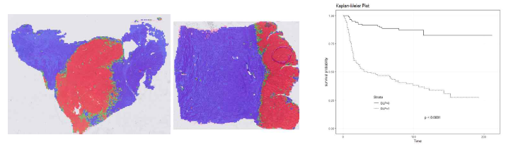 두경부 편평상피세포암 병리 조직에서 암 조직(붉은 색)을 기반으로 예후 예측