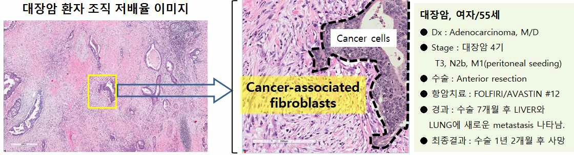 실제 말기 대장암으로 사망한 환자의 조직 사진. 암세포보다 10배 이상 많은 수의 Cancer associated fibroblast이 암세포를 둘러싸고 있음. 그래서 마치 CAF로 이루어진 바다위에 암세포들이 있는 것처럼 보임