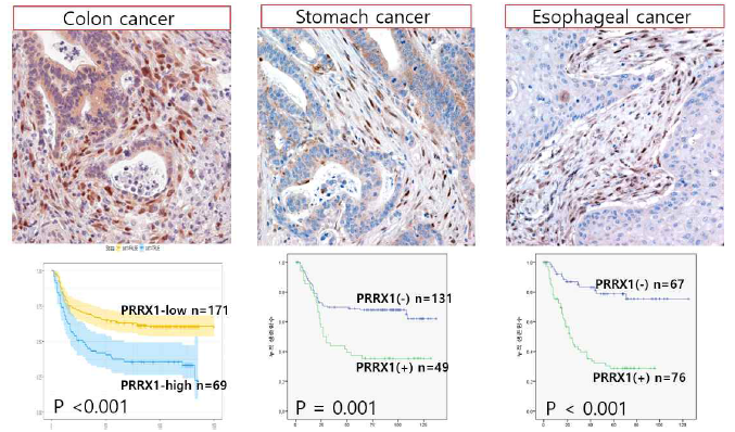 대장암과 위암, 식도암의 암연관 섬유아세포에서 Prrx1이 발현되며 이 들 모두에서 나쁜 예후와 뚜렷한 상관관계가 있음