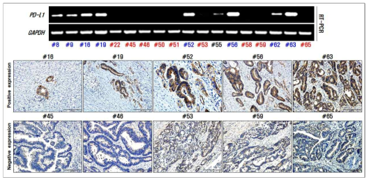 대장암 환자 PD-L1 발현 양상