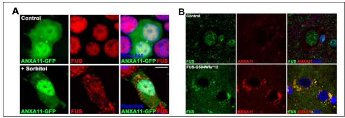 (A) Osmotic stress 조건에서 ANXA11와 endogenous FUS 관계 (B) 돌연변이 FUS ( p.G504Wfs * 2 ) ALS 환자 뇌 조직에서 ANXA11와 FUS의 colocalization