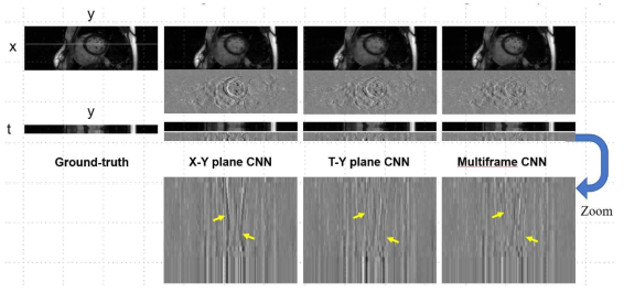 Reconstructed images and profiles by various CNN with an acceleration (compression) factor of 8. Error images are also shown