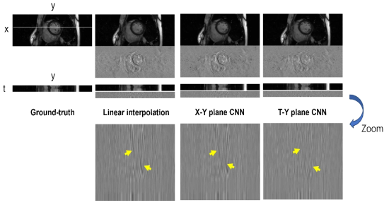 Reconstructed images and profiles with an acceleration factor of 4. Error images are shown below