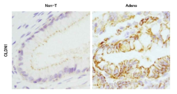 정상 조직 (왼쪽, Non-T)과 자궁 경부암 (오른쪽, Adeno)조직에서 claudin 1의 발현 패턴 비교