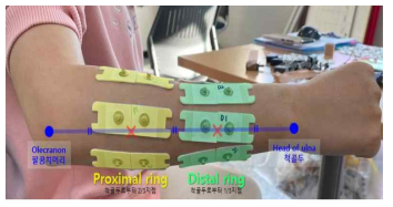 Proximal & Distal attachment