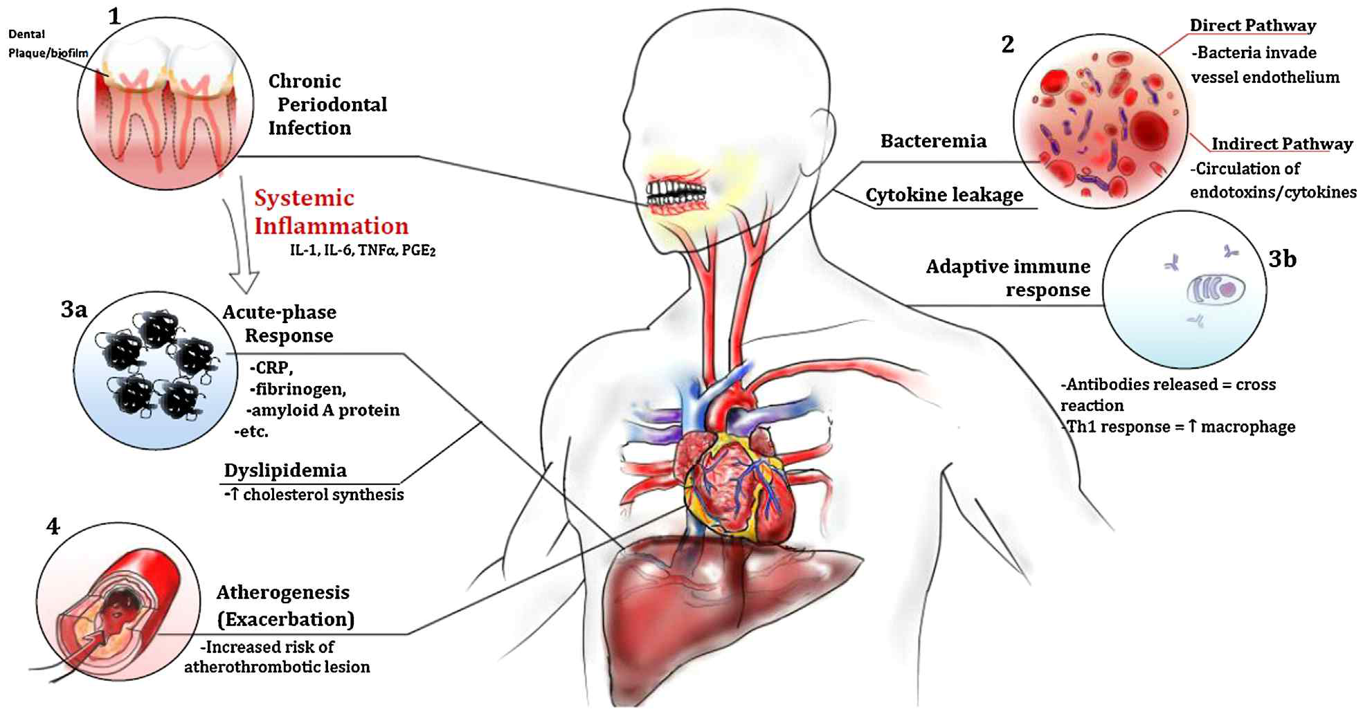 치주염에 의한 죽상 동맥경화(atherogenesis)의 생물학적 메커니즘