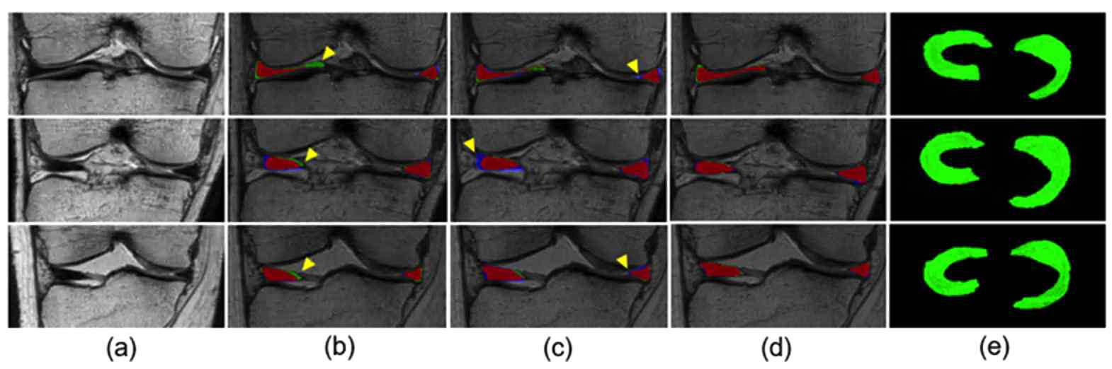 제안 방법을 적용한 반월상 연골 분할 결과 (a) 원본 영상, (b) Method A, (c) Method B, (d) Method C (e) 3차원 결과 영상 (빨간색: 수동 분할 결과와 일치, 초록색: 과소 분할, 파란색: 과대 분할)