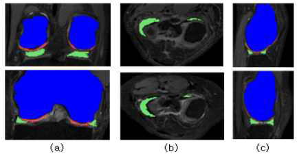 제안방법을 적용한 대퇴골, 대퇴부 연골, 반월상연골 분할 결과 (a) 관상면 (b) 축상면 (c) 시상면 (파란색: 대퇴골, 빨간색: 대퇴부 연골, 초록색: 반월상 연골)
