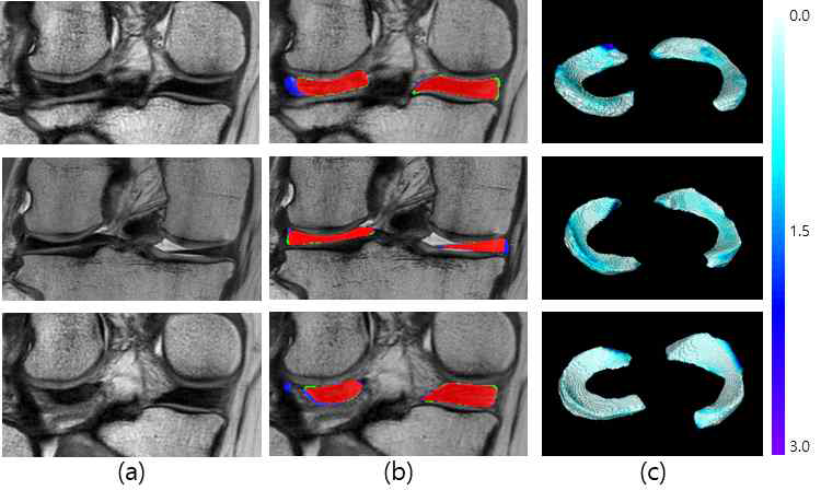 제안 방법을 적용한 반월상 연골 분할 결과: (a) 원본 영상, (b) 반월상 연골 분할 결과, (c) 3차원 컬러맵 (빨간색: 수동 분할 결과와 일치, 초록색: 과소 분할, 파란