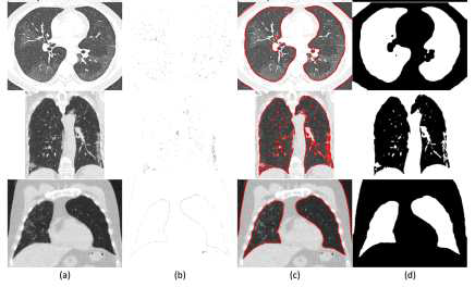 COVID-19 환자의 폐 이미지 SRIS 분할 결과. (a) 원본 이미지, (b) saliency information, (c) final contour, (d) 분할 결과
