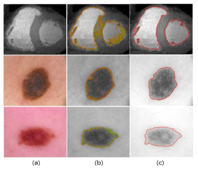 의료 이미지(a)에 대한 기존 영역분할 기법 결과(b)와 Active Contour 기반 proposed 기법 (c)