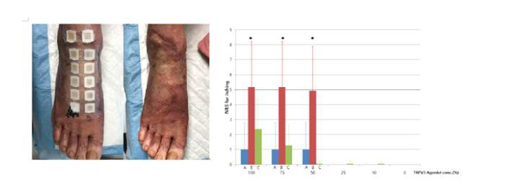 화상환자의 병변부위에 TRPV3 activator (Carvacrol) 로 가려움증 유발 시 일반인과 화상환 자의 비병변부위에 비해 더욱 심하게 가려움증 유도됨