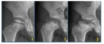 Perthes병의 자연 경과: 1).초기 괴사단계, 2).분절화기 3).후기 골재형성