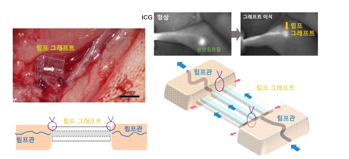 상완 림프절 절제 후 림프 그래프트 이식 부위로 ICG 조영 영상이 거의 정상 상태와 비슷한 것을 확인할 수 있으며, 이를 통해 림프액의 흐름이 림프 그래프트에 의 해 잘 유지됨을 확인할 수 있음