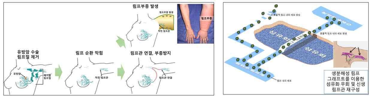 (좌)림프부종의 병인과 림프관 연결을 통한 부종방지 모식도, (우)림프 그래프트를 이용한 치료전략 모식도