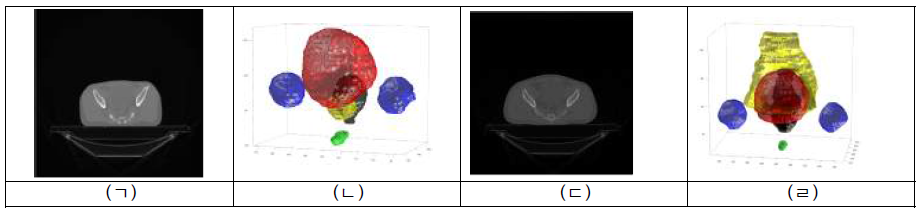 Prostate case의 (ㄱ) 시뮬레이션-CT, (ㄴ) 장기도해 데이터, Pelvic case의 (ㄷ) 시뮬레이션-CT, (ㄹ) 장기도해 데이터