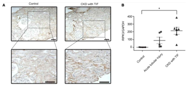 만성콩팥병 환자 조직에서 Ripk3 조직면역염색법 (A), Ripk3 mRNA 발현 (B). [Imamura M et al. JCI Insight. (2018)]