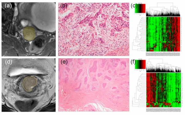 높은 tumor budding count를 보이는 케이스 (a,b,c)와 낮은 tumor budding count 를 보이는 케이스 (d,e,f)의 비교