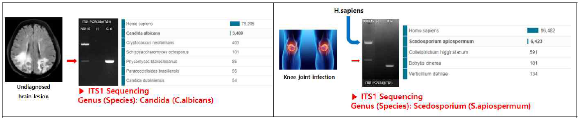 원인미상의 뇌병변 환자의 뇌조직(좌) 및 무릎 감염 환자의 관절액(우)에서 ITS1시퀀싱으로 원인 진균을 진단함