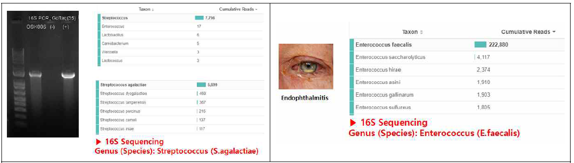 무릎 감염환자의 관절액(좌) 및 안내염 환자 안구방수(우)에서 16S시퀀싱으로 원인세균을 진단함