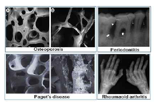 파골세포로 인한 골 질환들