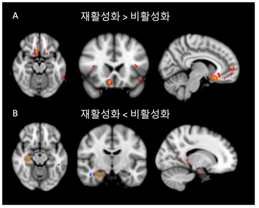 fMRI 실험 결과. A. 비활성화 조건에 비해 재활성화 조건에 대해 더 큰 활성화 정도를 보인 영역(붉은색). B. 재활성화 조건에 비해 비활성화 조건에 대해 더 큰 활성화 정도를 보인 영역(파란색). 우측 해마에 해당하는 해부학적 ROI를 반투명한 붉은색으로 표시함. p < .05 (uncorrected)