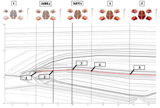 비선형 generative 모델 기반 치매 latent 공간에서의 interpolation 결과