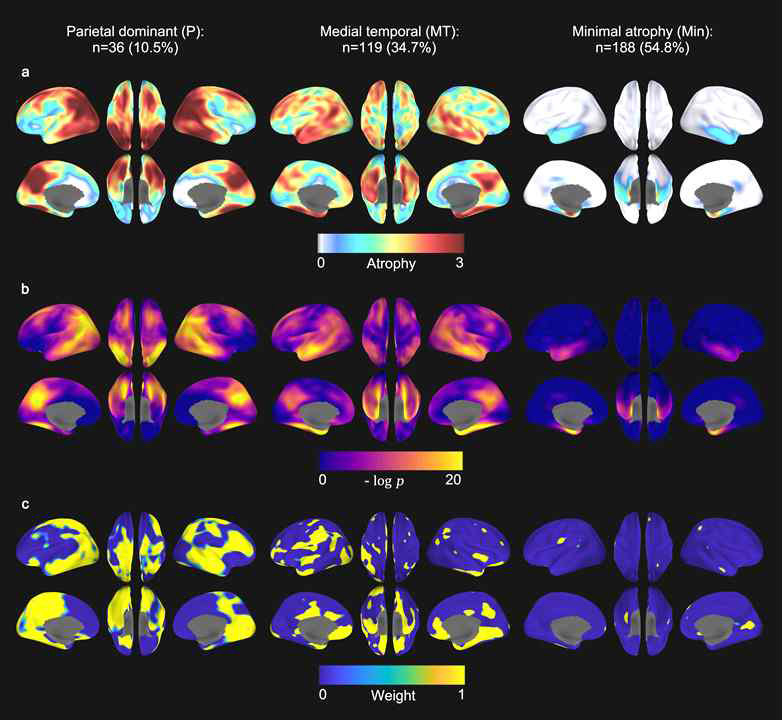 개별 모달(neurodegeneration)의 서브타입 분석 결과