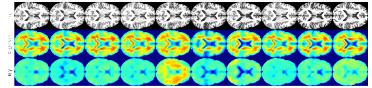 실제 환자들의 T1 MR 영상으로부터 생성한 아밀로이드 PET 및 타우 PET 영상