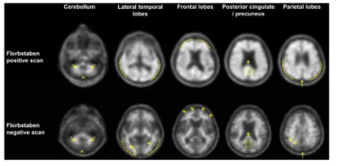 Amyloid PET 진단 시 사용되는 영역(가이드라인)