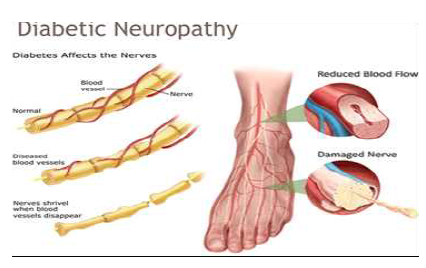 당뇨병성 말초신경병증(Diabetic Neuropathy. 당뇨병의 3대 합병증으로 발생하며 주로 신체의 말단인 발의 감각신경섬유와 운동신경섬유 손상을 초래하여 통증, 감각둔화, 과민감각증상 등을 유발함