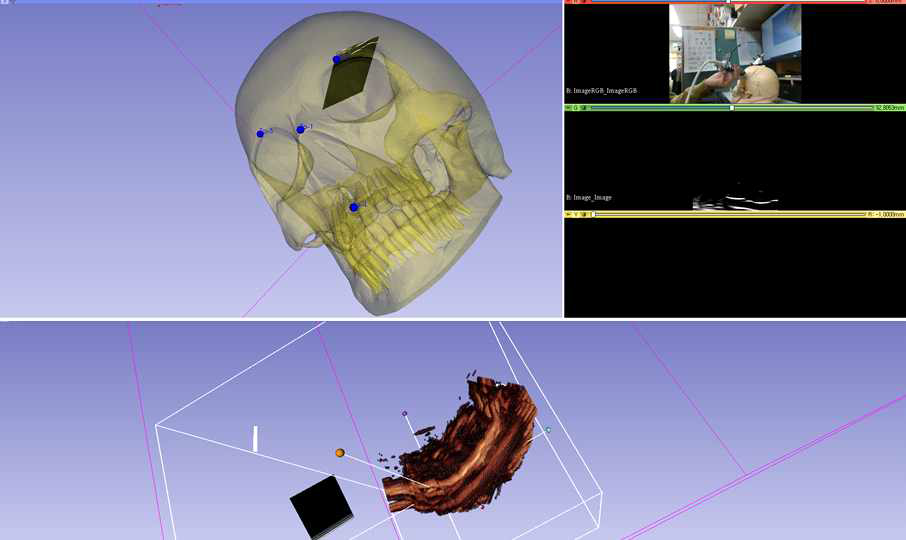 모션캡쳐 장비를 이용한 3D 초음파 구현, 위)스컬모형을 이용한 3D 초음파 보정 및 시험, 아래)턱끝부위에 대한 3D 초음파 촬영