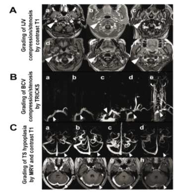 MRI venous drain grading