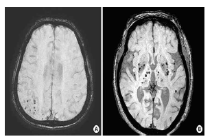 Cerebral microbleeds